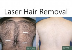 laser hair removal north harrow